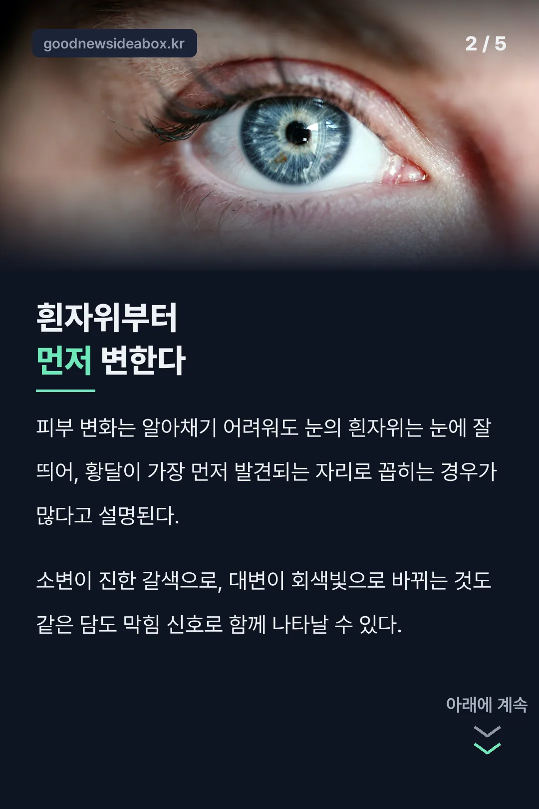 눈 흰자위부터 먼저 변하는 황달의 특징